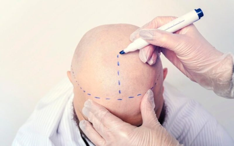 FUE Hair Transplant
