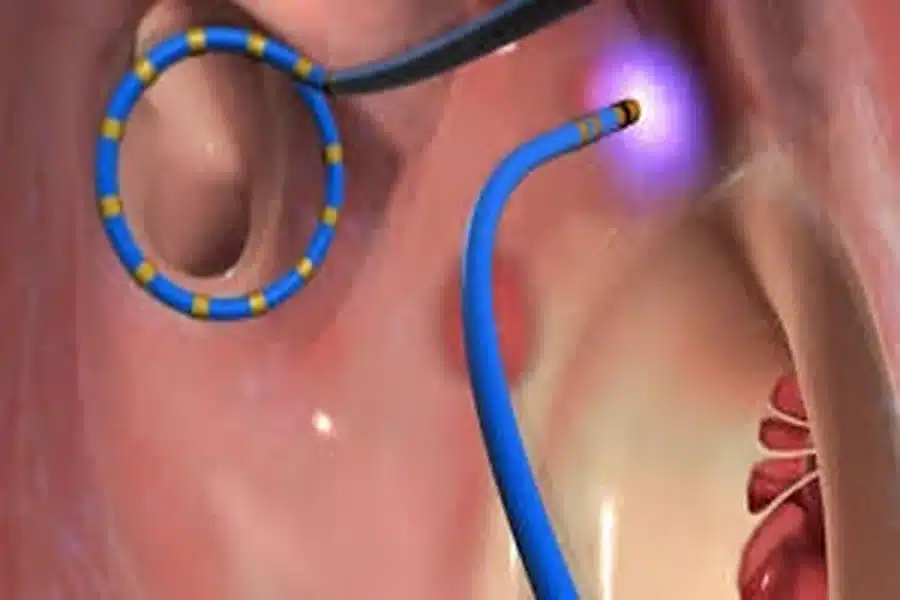 Cardiac Ablation