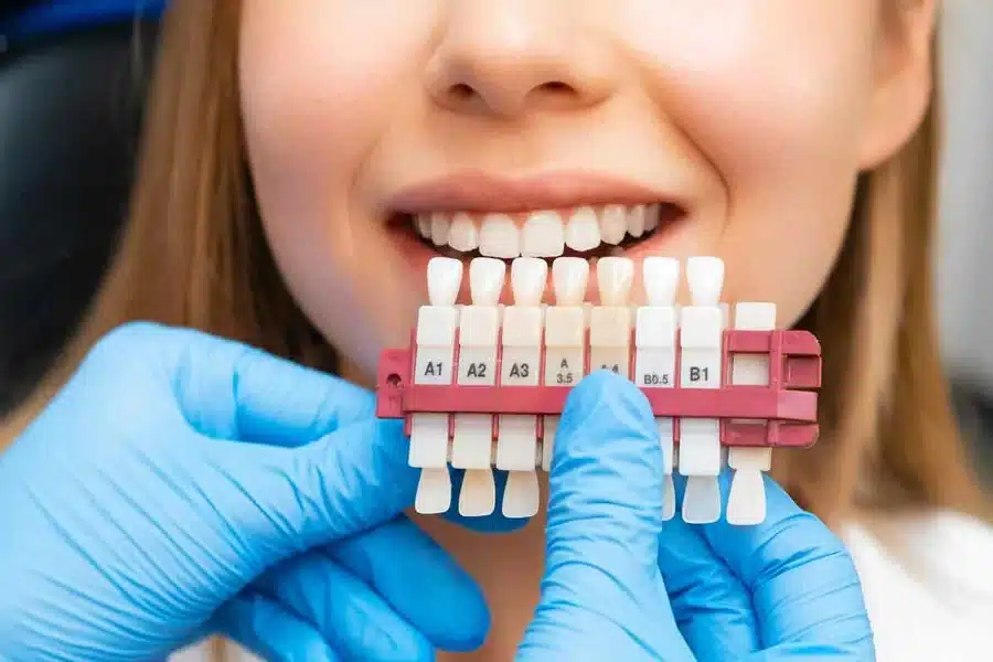 Cost of Veneers in 2025
