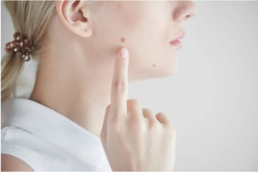 Safely Remove Moles