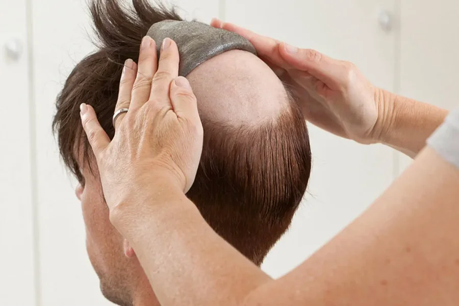 Hair Replacement Solutions