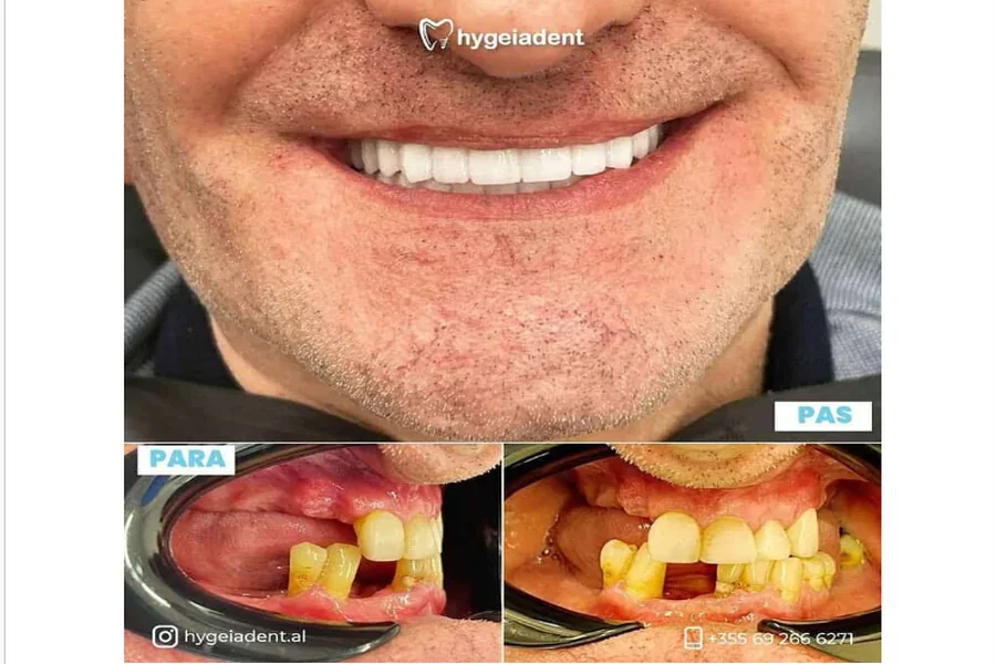 Digital Smile Design: Visualizing Confidence Before Treatment