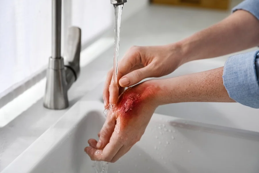Burn Injury