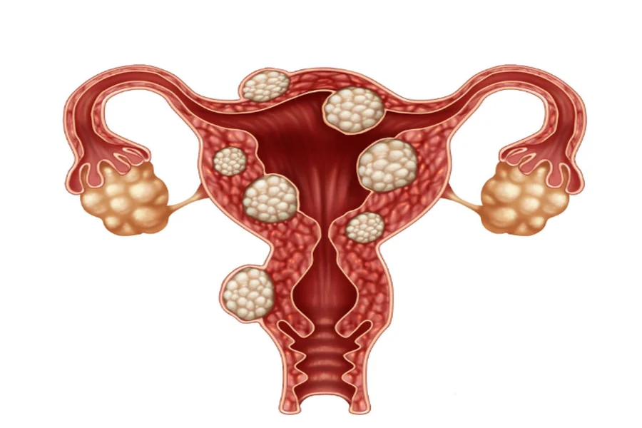 Uterine Fibroids