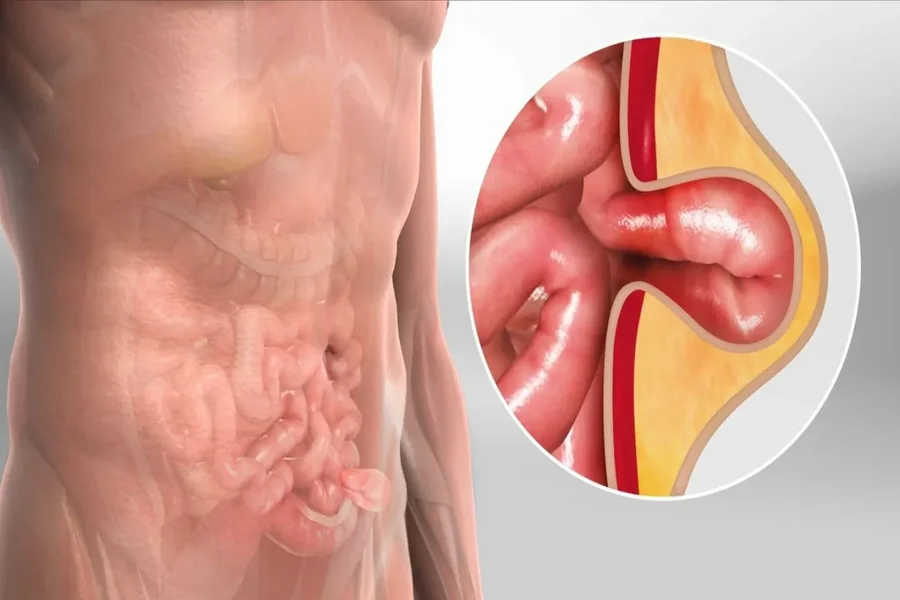 Mesh Hernia Repair