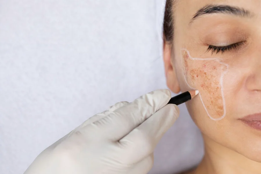 Stubborn Melasma