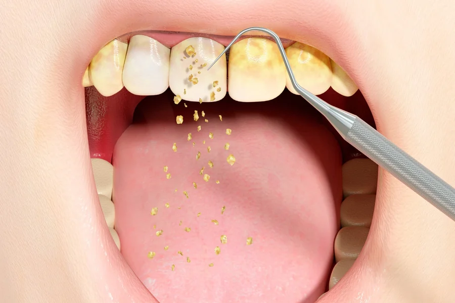 Is It Better to Remove a Problem Tooth Early or Wait
