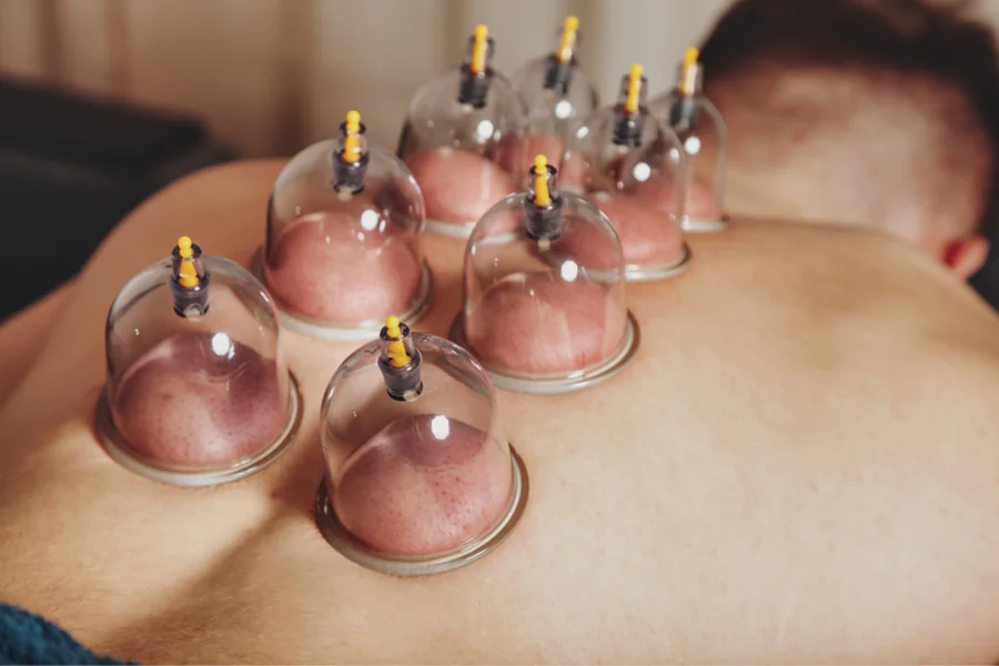 Best Places to Get Cupping Therapy in NYC
