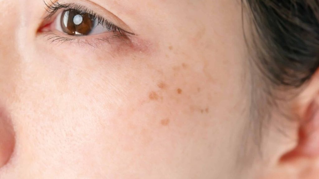 Pigmentation